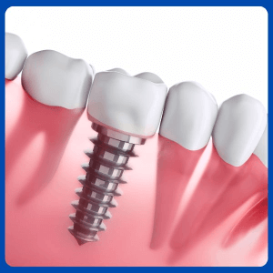 3d guided implant surgery in dubai