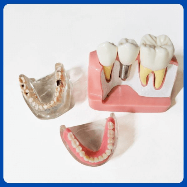 Osseointegration process for dental implants in Dubai
