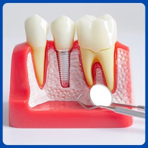Dental implants cavities