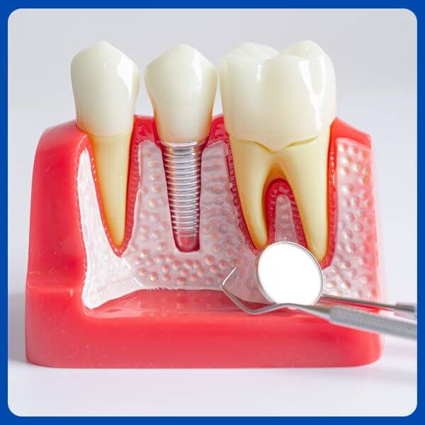 Dental implants cavities